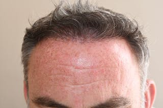 Hair Restoration for Men Before & After Gallery - Patient 304038 - Image 4