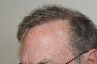 Hair Restoration for Men Before & After Gallery - Patient 383578 - Image 2