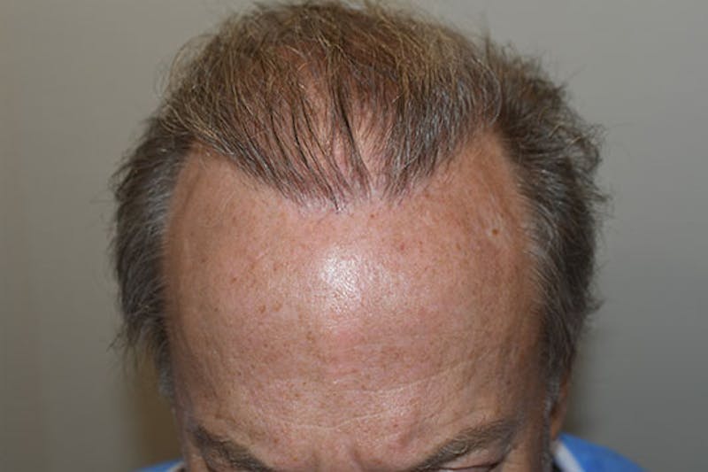 Hair Restoration for Men Before & After Gallery - Patient 383578 - Image 3