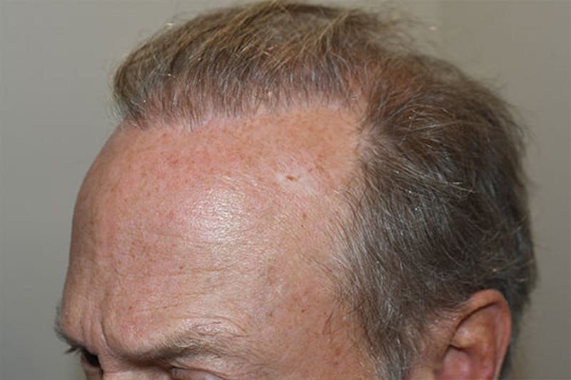 Hair Restoration for Men Before & After Gallery - Patient 383578 - Image 1