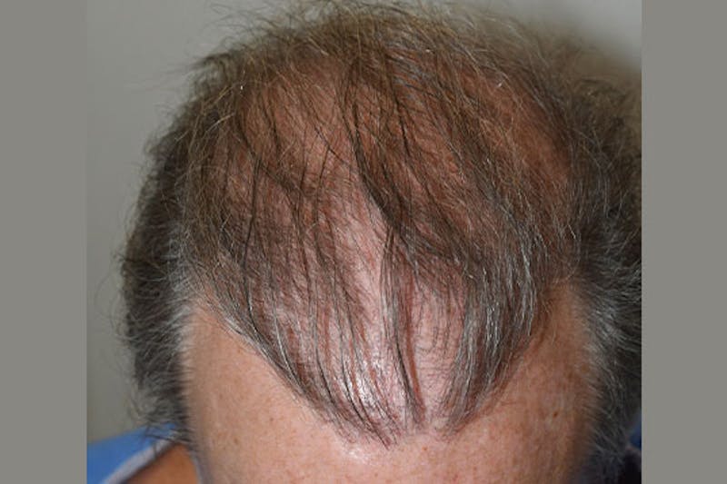 Hair Restoration for Men Before & After Gallery - Patient 383578 - Image 5