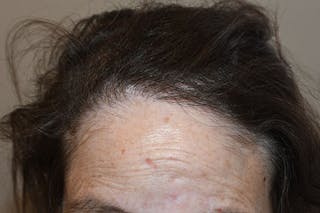 Hair Procedures for Women Before & After Gallery - Patient 778733 - Image 4