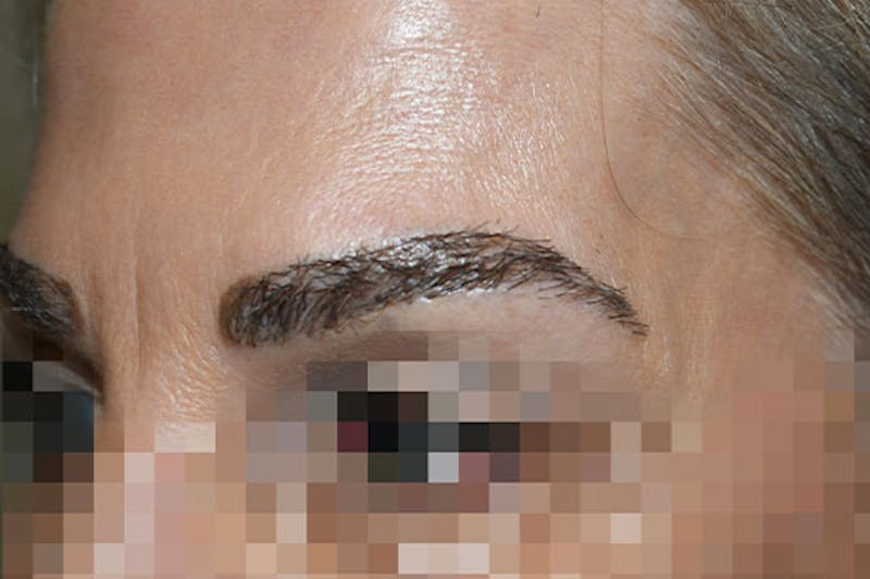 Eyebrow Transplantation Before & After Gallery - Patient 651492 - Image 4