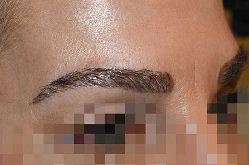 Eyebrow Transplantation Before & After Gallery - Patient 651492 - Image 6