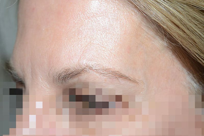 Eyebrow Transplantation Before & After Gallery - Patient 651492 - Image 3