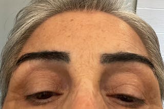 Eyebrow Transplantation Before & After Gallery - Patient 216317 - Image 4