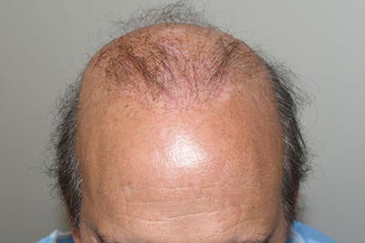 Hair Restoration for Men Before & After Gallery - Patient 123307 - Image 1