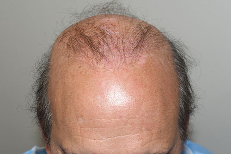 Hair Restoration for Men Before & After Gallery - Patient 123307 - Image 1