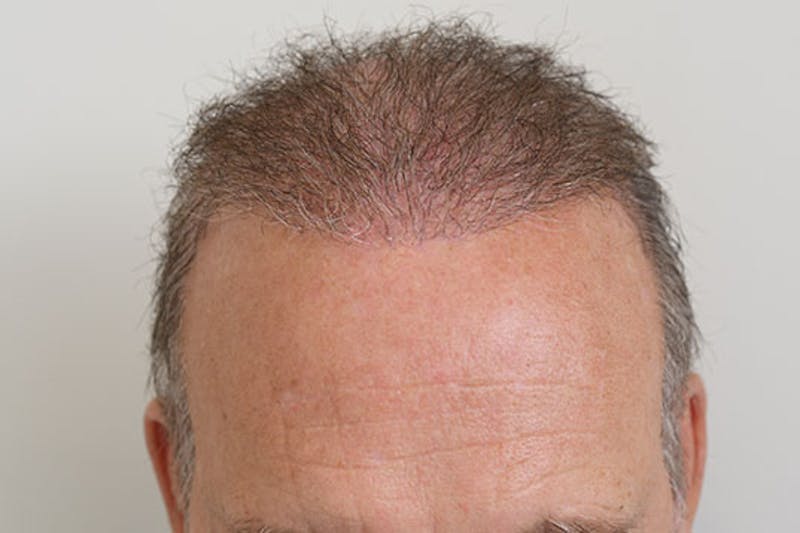 Hair Restoration for Men Before & After Gallery - Patient 123307 - Image 2