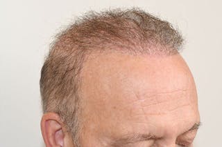 Hair Restoration for Men Before & After Gallery - Patient 123307 - Image 4