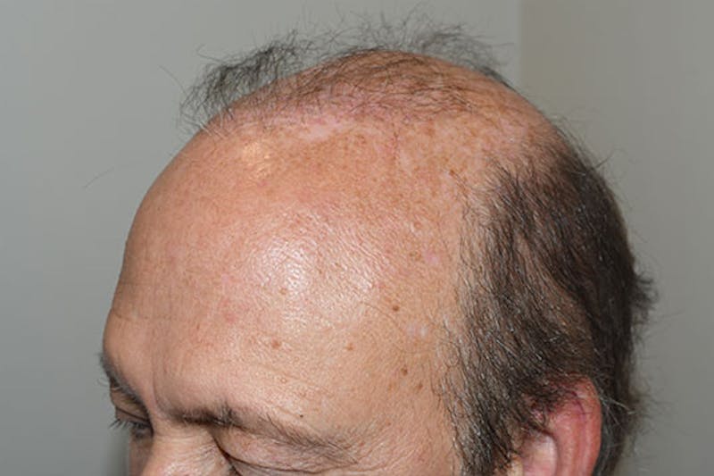 Hair Restoration for Men Before & After Gallery - Patient 123307 - Image 5