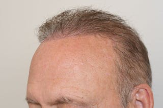 Hair Restoration for Men Before & After Gallery - Patient 123307 - Image 6