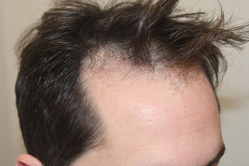 Hair Restoration for Men Before & After Gallery - Patient 265552 - Image 1