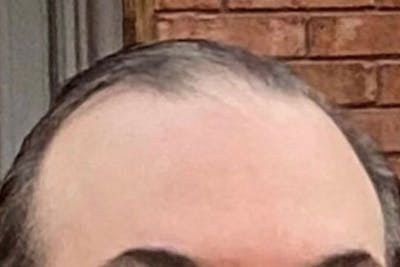 Hair Restoration for Men Before & After Gallery - Patient 189933 - Image 1