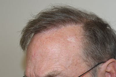 Body Hair Transplants Before & After Gallery - Patient 404562 - Image 2