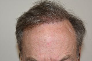 Hair Transplant Repair Before & After Gallery - Patient 428539 - Image 4