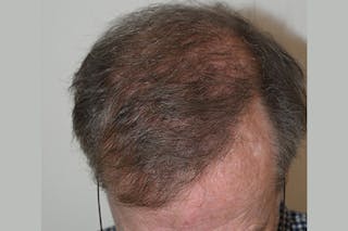 Hair Transplant Repair Before & After Gallery - Patient 428539 - Image 6
