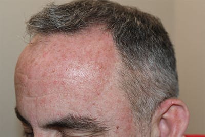 Hair Restoration for Men Before & After Gallery - Patient 247458 - Image 1