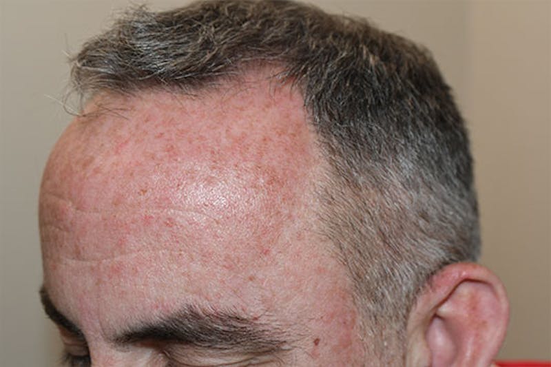 Hair Restoration for Men Before & After Gallery - Patient 247458 - Image 1