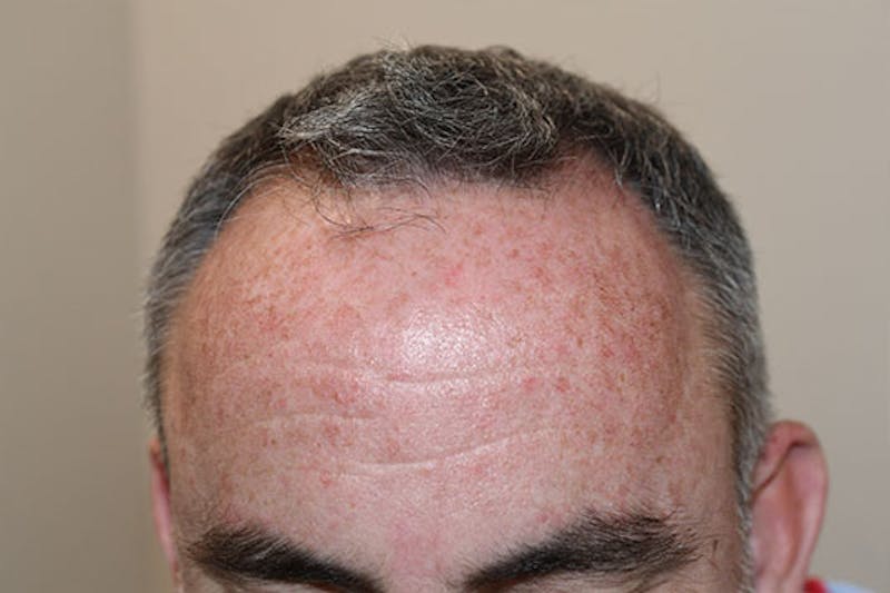 Hair Restoration for Men Before & After Gallery - Patient 247458 - Image 3