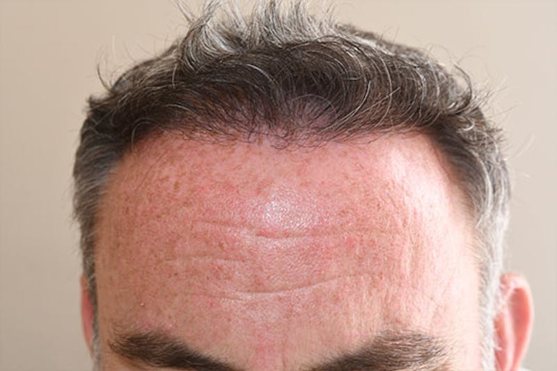 Hair Restoration for Men Before & After Gallery - Patient 247458 - Image 4