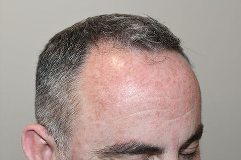 Hair Restoration for Men Before & After Gallery - Patient 247458 - Image 5
