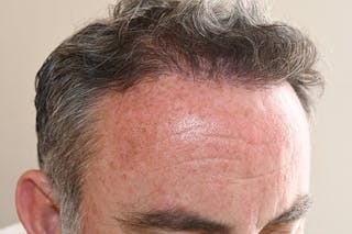 Hair Restoration for Men Before & After Gallery - Patient 108626 - Image 6