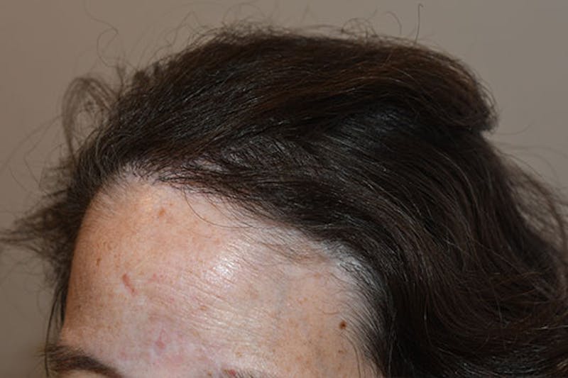 Hair Procedures for Women Before & After Gallery - Patient 105726 - Image 2