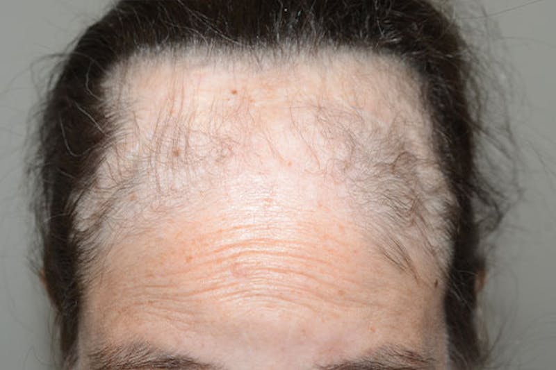 Hair Procedures for Women Before & After Gallery - Patient 105726 - Image 3