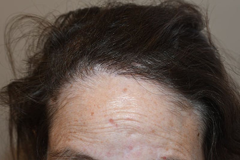 Hair Procedures for Women Before & After Gallery - Patient 105726 - Image 4