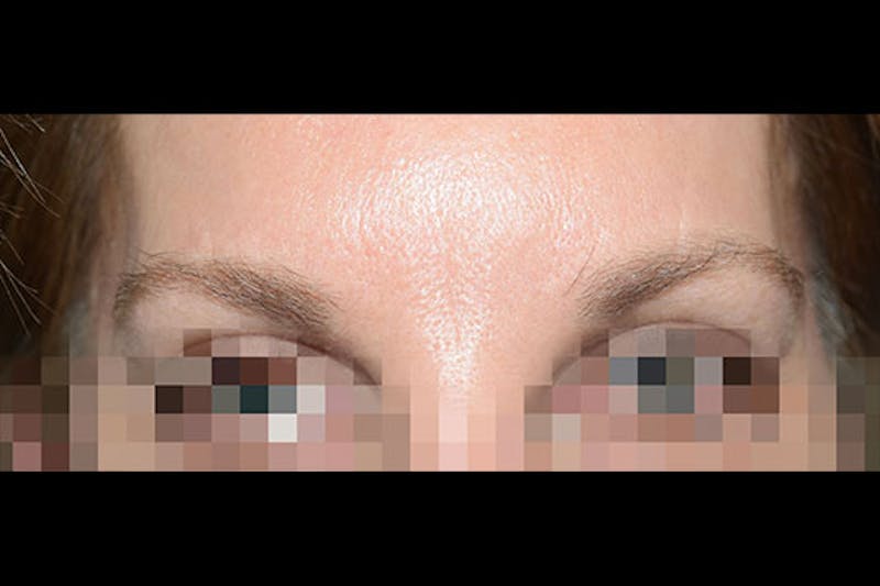 Eyebrow Transplantation Before & After Gallery - Patient 249130 - Image 1