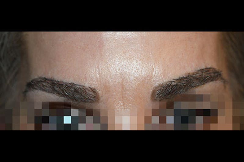 Eyebrow Transplantation Before & After Gallery - Patient 249130 - Image 2