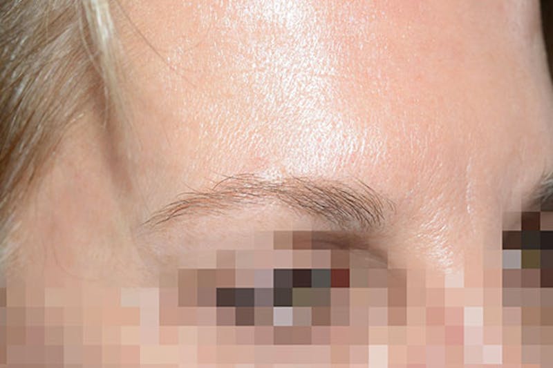 Eyebrow Transplantation Before & After Gallery - Patient 249130 - Image 5