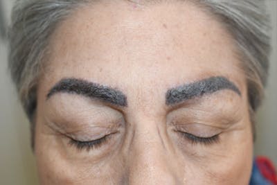 Eyebrow Transplantation Before & After Gallery - Patient 190469 - Image 1