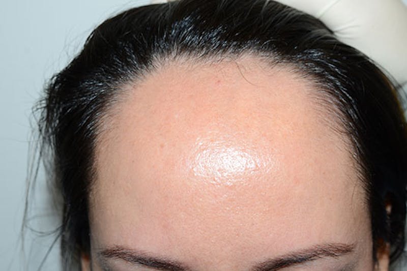 Hairline Lowering Surgery Before & After Gallery - Patient 413626 - Image 1