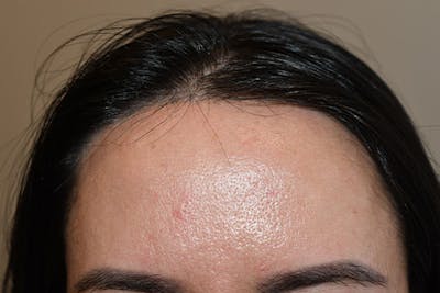 Hairline Lowering Surgery Before & After Gallery - Patient 413626 - Image 2