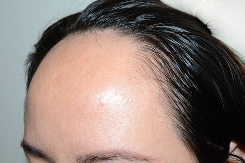 Hairline Lowering Surgery Before & After Gallery - Patient 413626 - Image 3