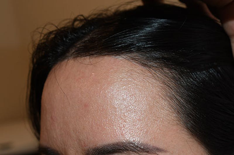 Hairline Lowering Surgery Before & After Gallery - Patient 413626 - Image 4