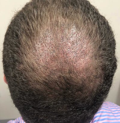 SMP Procedures Before & After Gallery - Patient 826221 - Image 2