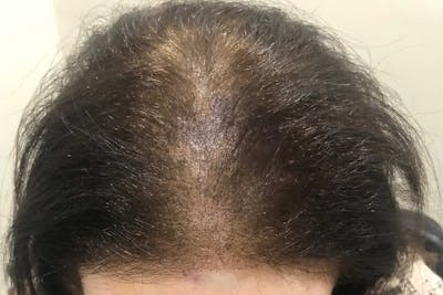SMP Procedures Before & After Gallery - Patient 262614 - Image 2