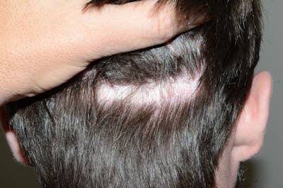 SMP Procedures Before & After Gallery - Patient 304575 - Image 1