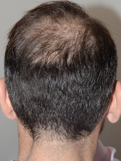 SMP Procedures Before & After Gallery - Patient 300130 - Image 1