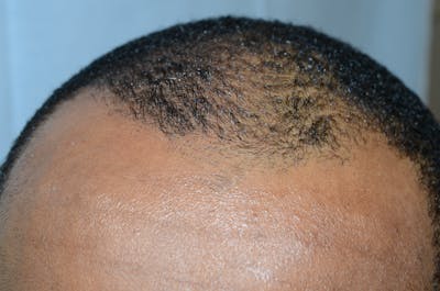 SMP Procedures Before & After Gallery - Patient 152738 - Image 1