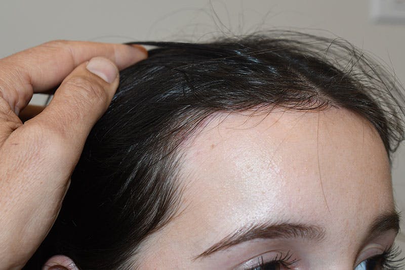 Hairline Lowering Surgery Before & After Gallery - Patient 189195 - Image 4