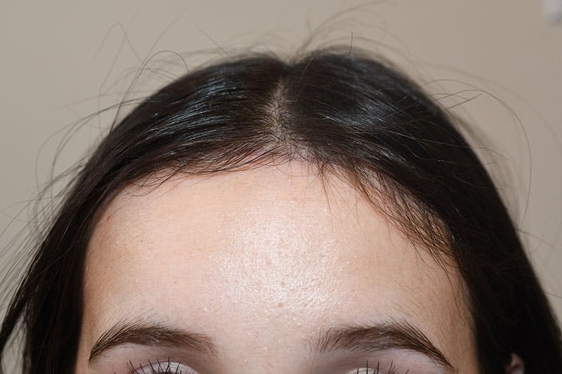 Hairline Lowering Surgery Before & After Gallery - Patient 189195 - Image 2