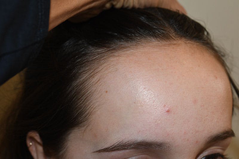 Hairline Lowering Surgery Before & After Gallery - Patient 189195 - Image 3
