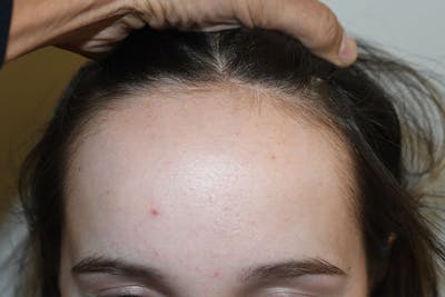Hairline Lowering Surgery Before & After Gallery - Patient 189195 - Image 1