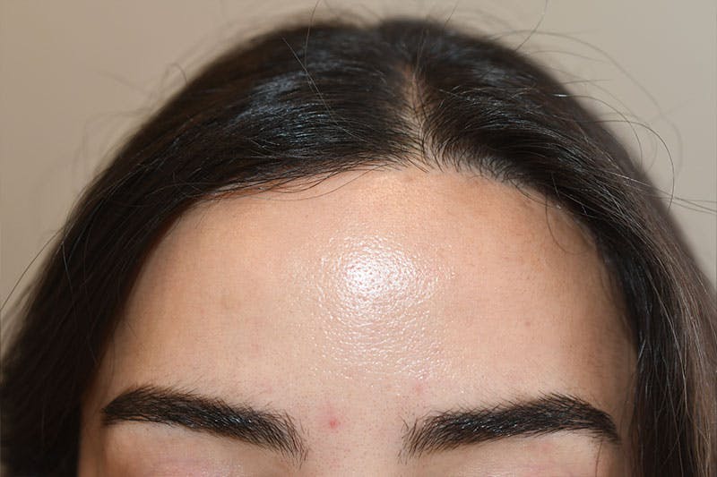 Hairline Lowering Surgery Before & After Gallery - Patient 133676 - Image 2