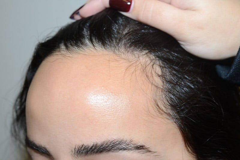 Hairline Lowering Surgery Before & After Gallery - Patient 133676 - Image 3