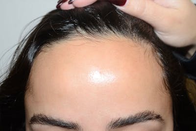 Hairline Lowering Surgery Before & After Gallery - Patient 133676 - Image 1